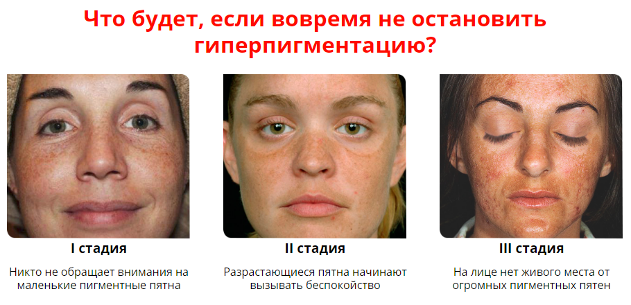 Пигментные пятна - как с ними бороться?