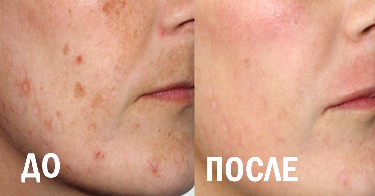 Пигментные пятна - как с ними бороться?