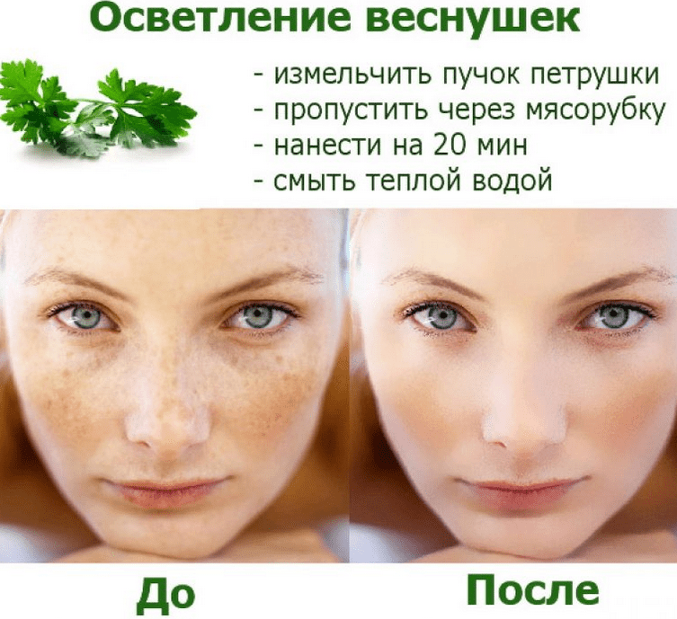 Пигментные пятна - как с ними бороться?