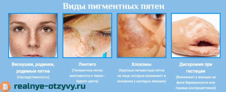Пигментные пятна - как с ними бороться?