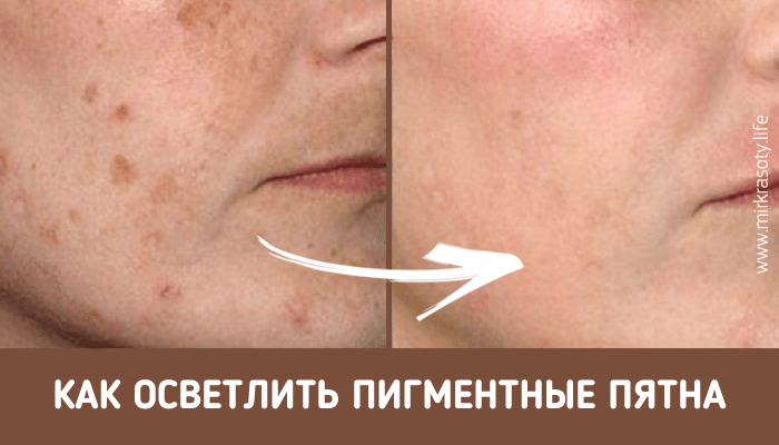Пигментные пятна - как с ними бороться?
