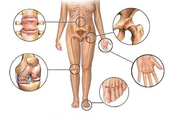 Эффективное средство для избавления от боли в коленях, восстановления суставов и костей