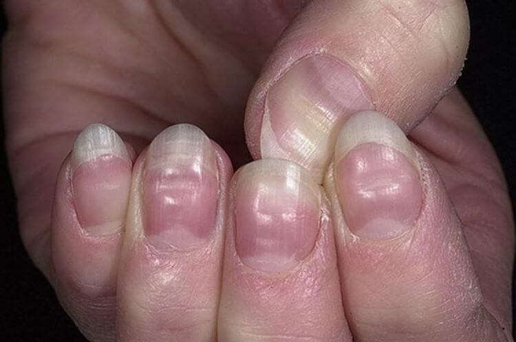 7 важных вещей о здоровье, о которых смогут рассказать ваши ногти: просто изучите свои руки