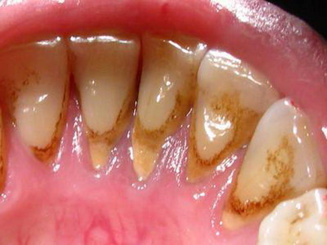 Хотите избавиться от зубного камня быстро и эффективно, без посещения стоматолога?